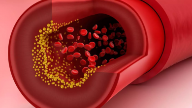 Yüksek Kolesterol Nasıl Kontrol Altına Alınır?